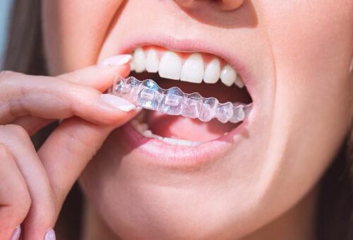 Imagen Chica colocando Brackets en Clinica Dental Oropesa