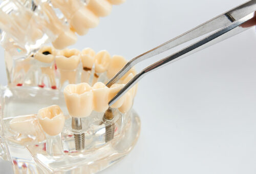 Imagen Implantes dentales en clínica dental, Oropesa